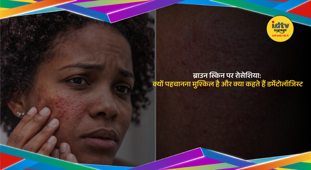 Brown skin with rosacea symptoms showing bumps, irritation, and discoloration on cheeks