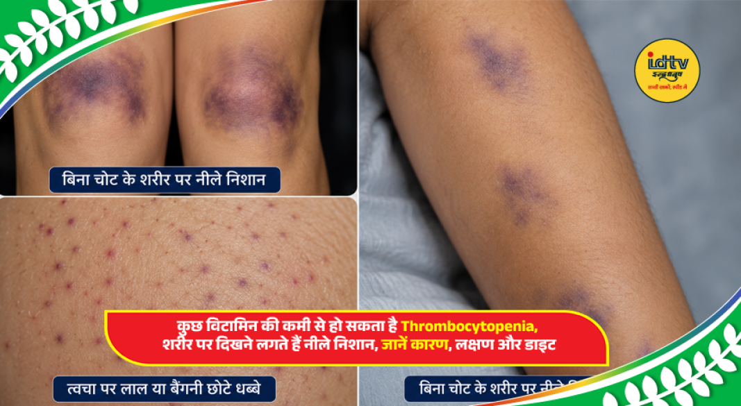 Person showing unexplained bruises on arm with healthy foods supporting platelet-friendly nutrition and vitamins.