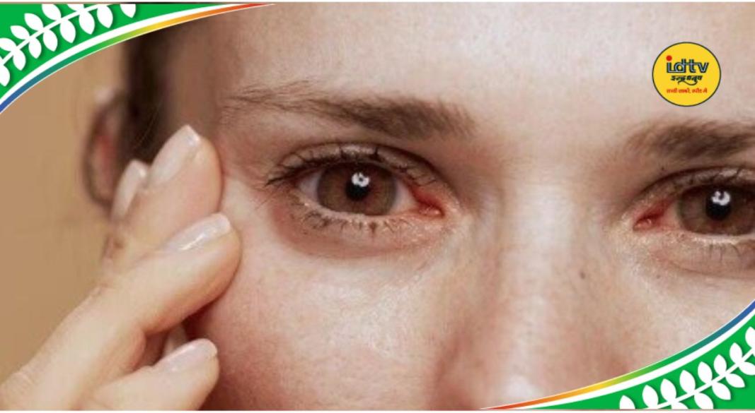 Thyroid Eye Disease