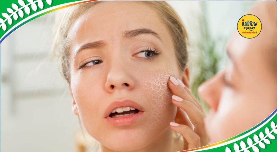 Summer acne remedies